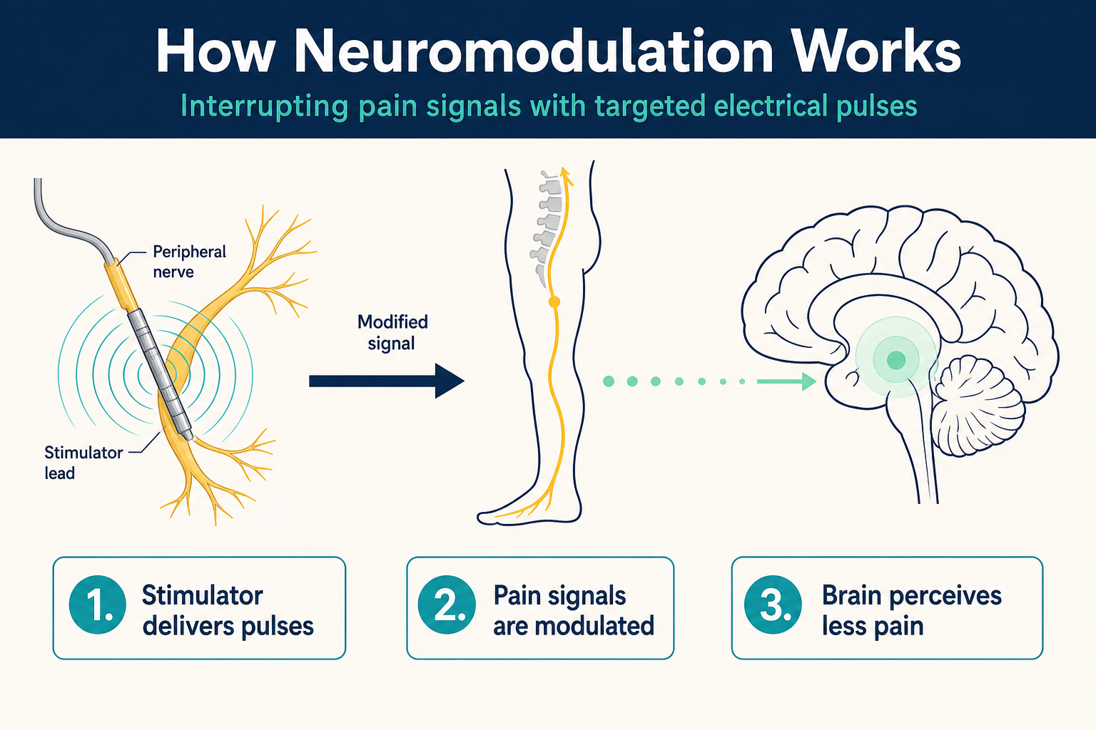 Infographic: What Is Neuromodulation? A Guide for Patients and Providers